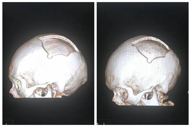 因头颅颅骨缺损畸形不仅影响美观,还会有再次头部碰撞引起颅内损伤